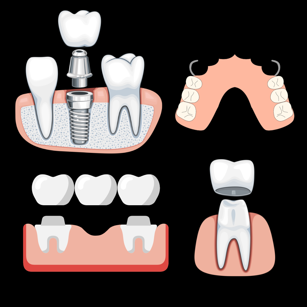 Missing Teeth Replacement